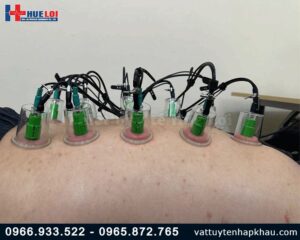 Máy châm cứu không kim kết hợp giác hút