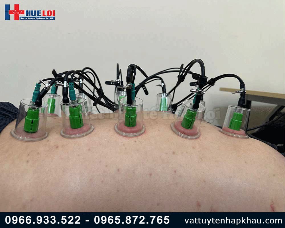 Máy châm cứu không kim kết hợp giác hút